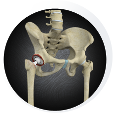 Revision hip replacement
