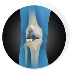 Unicompartmental knee replacement