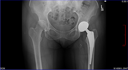 Total Hip Replacement