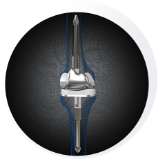 Revis Knee replacement