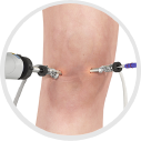 Knee Arthroscopic Surgery