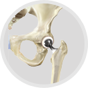 Revision Hip & Knee Replacement