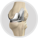 Unicondylar Knee Replacement